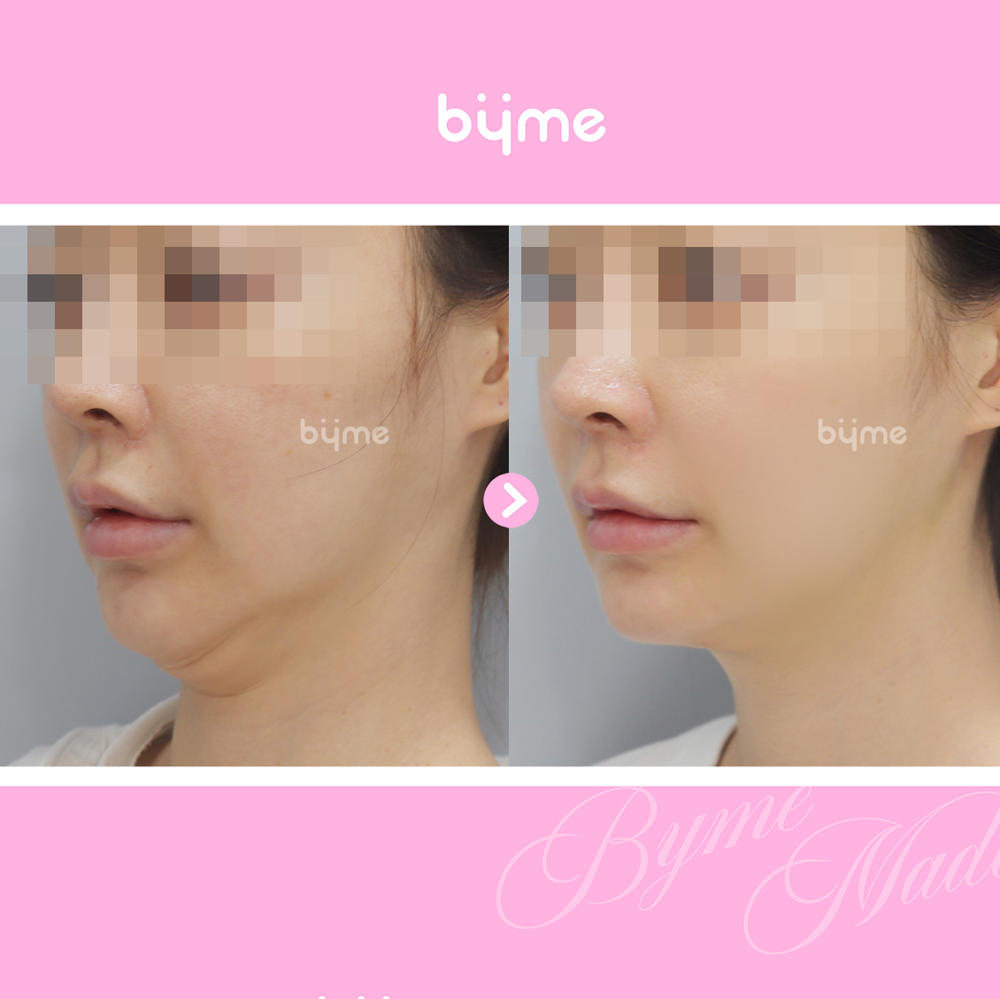 근육묶기7.jpg
