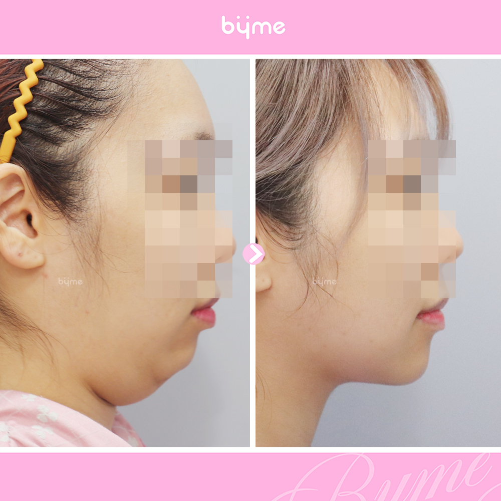 근육묶기_민채린_옆전후.jpg