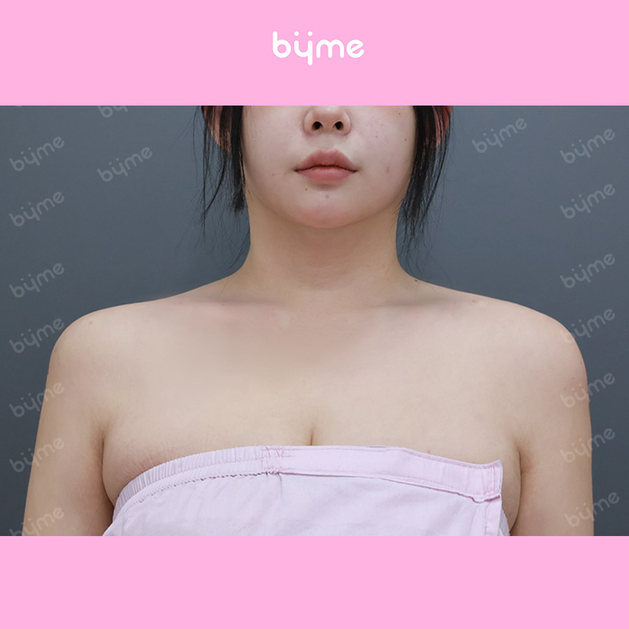 어깨필러_전지은_후 (1).jpg