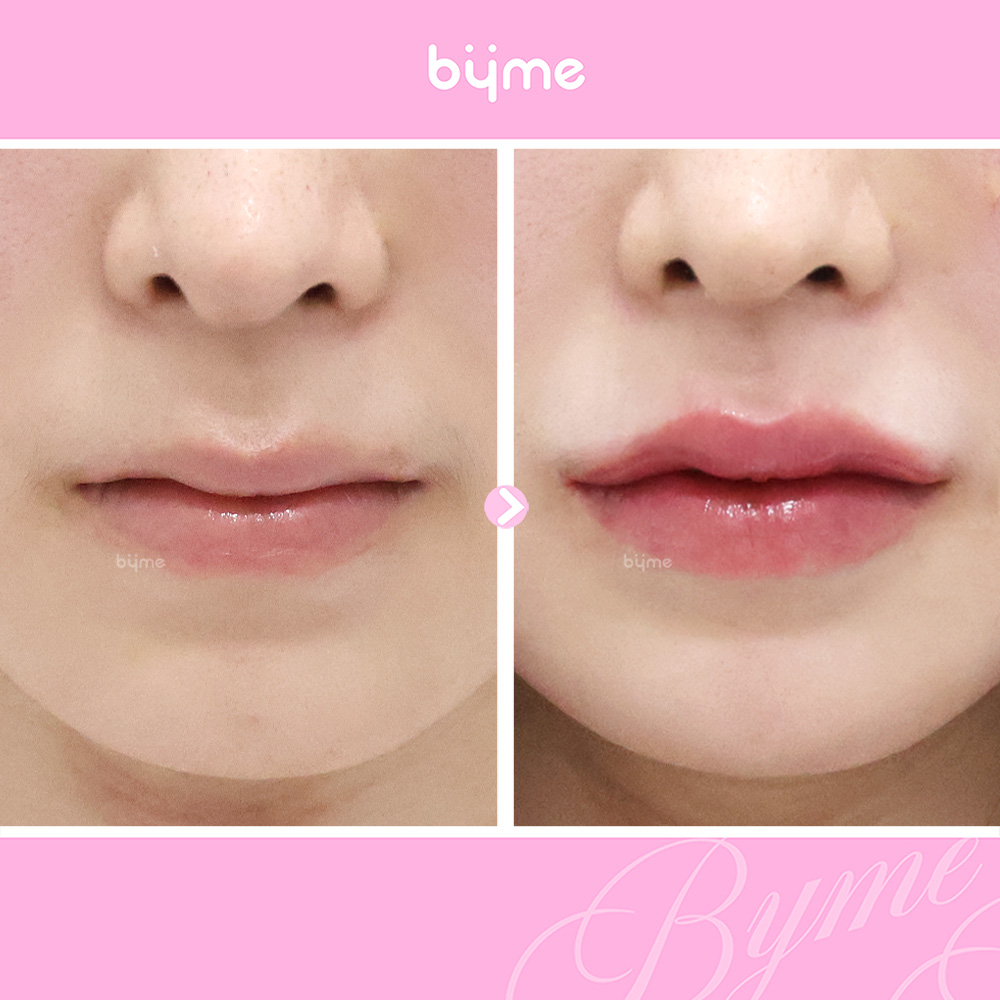 예비신부_웨딩시술_추천시기_바이미성형외과_입술필러 전후사진02.jpg
