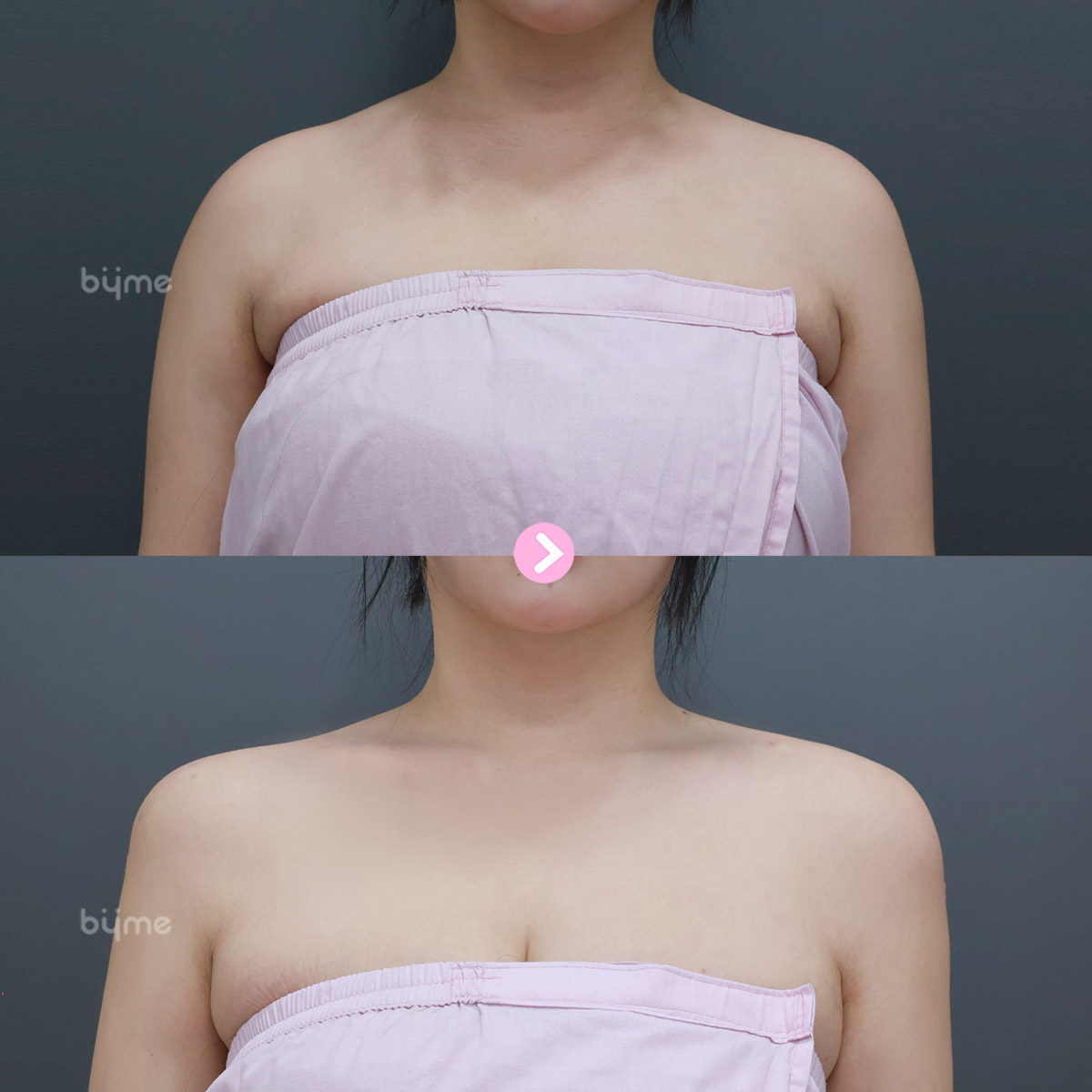 예비신부_웨딩시술_추천시기_바이미성형외과_어깨필러 전후사진02.jpg