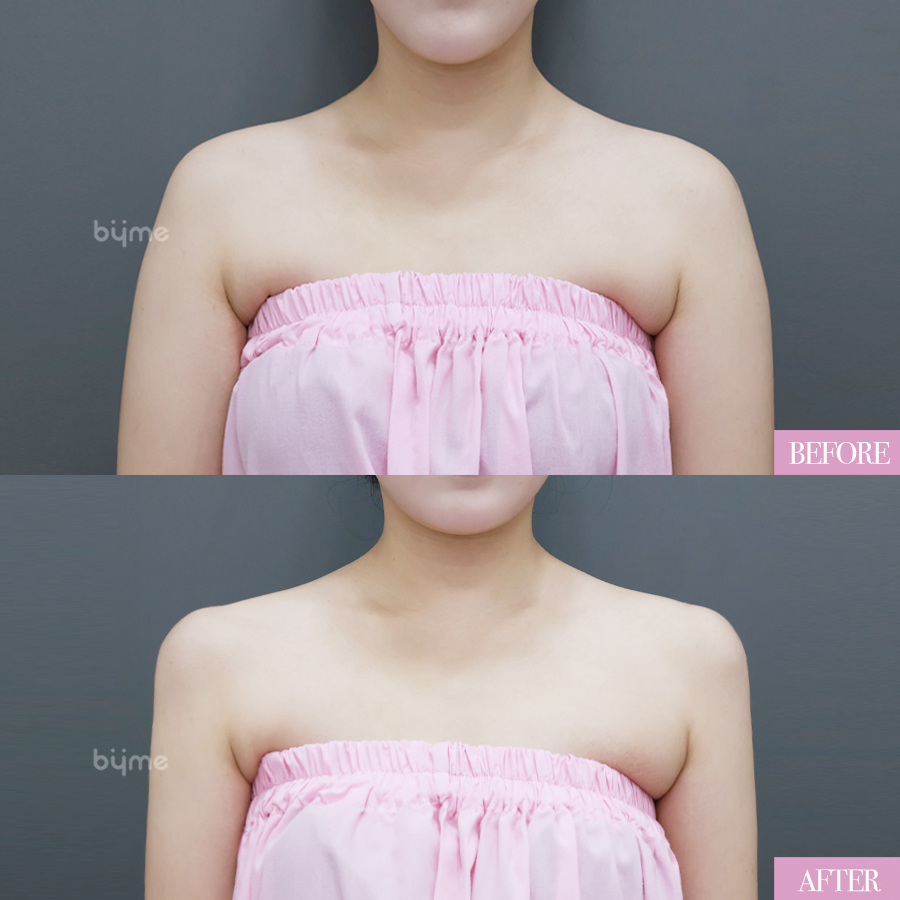 예비신부_웨딩시술_추천시기_바이미성형외과_어깨필러 전후사진04.jpg