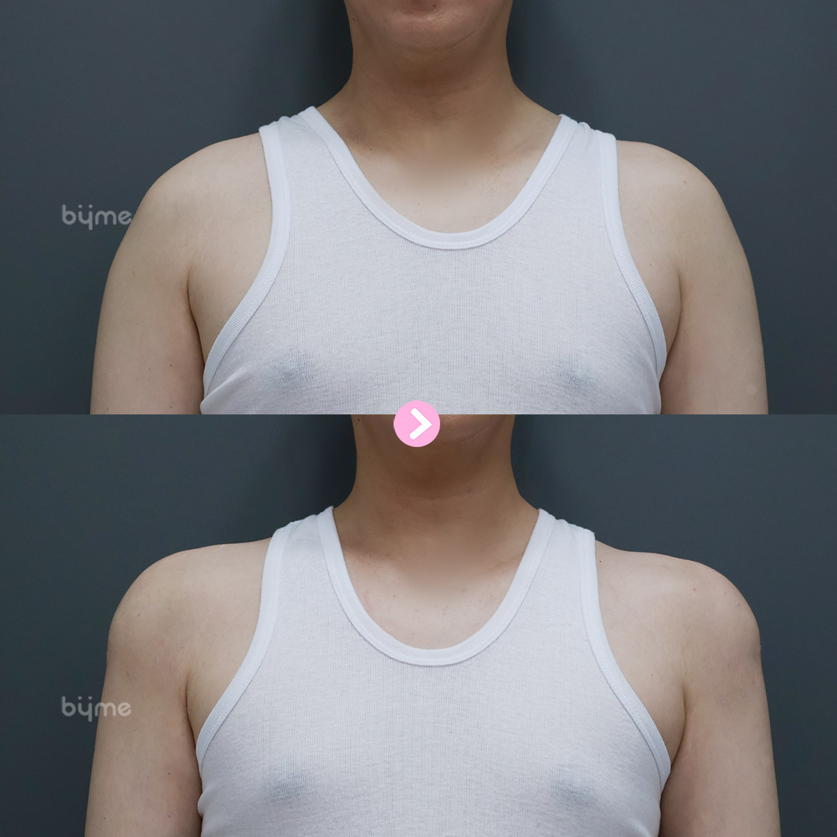 예비신랑_웨딩시술_바이미성형외과_남자 어깨필러 전후사진01.jpg