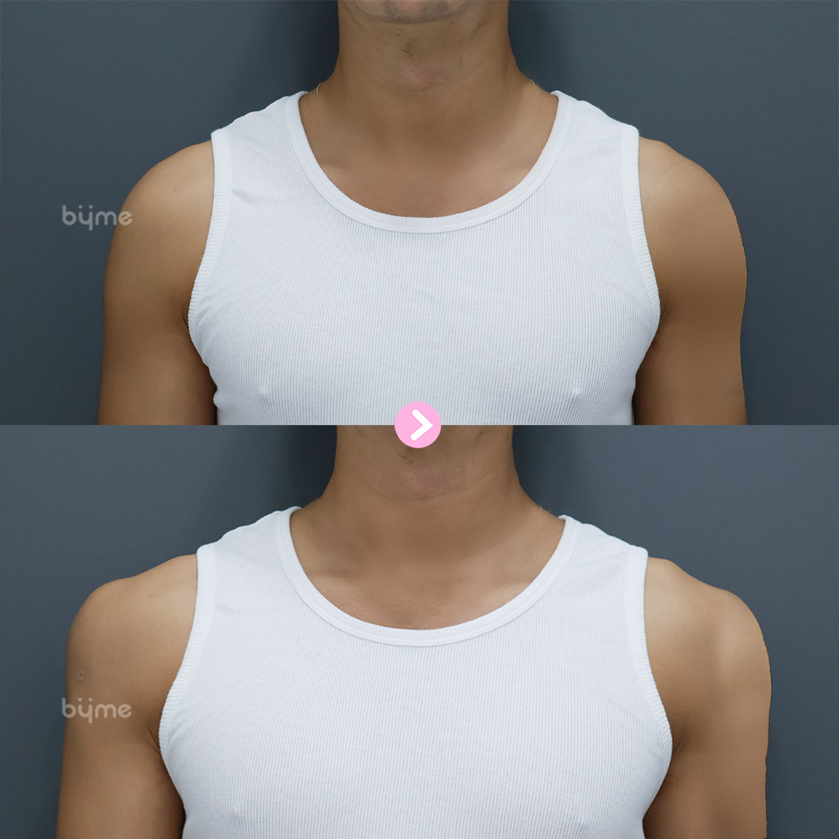 예비신랑_웨딩시술_바이미성형외과_남자 어깨필러 전후사진02.jpg