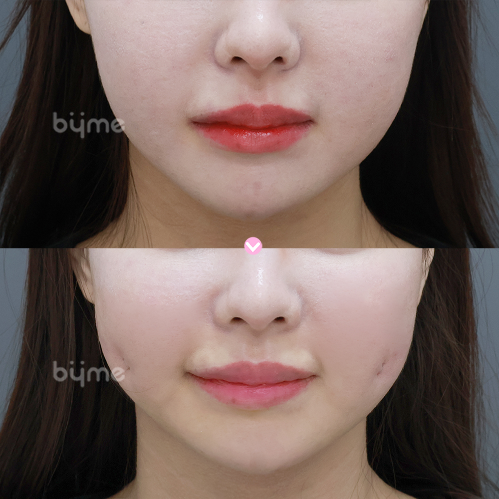 보조개_박주희_전후.jpg