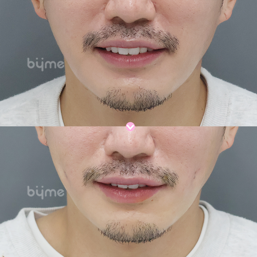 보조개_ 코가 아키라_전후.jpg