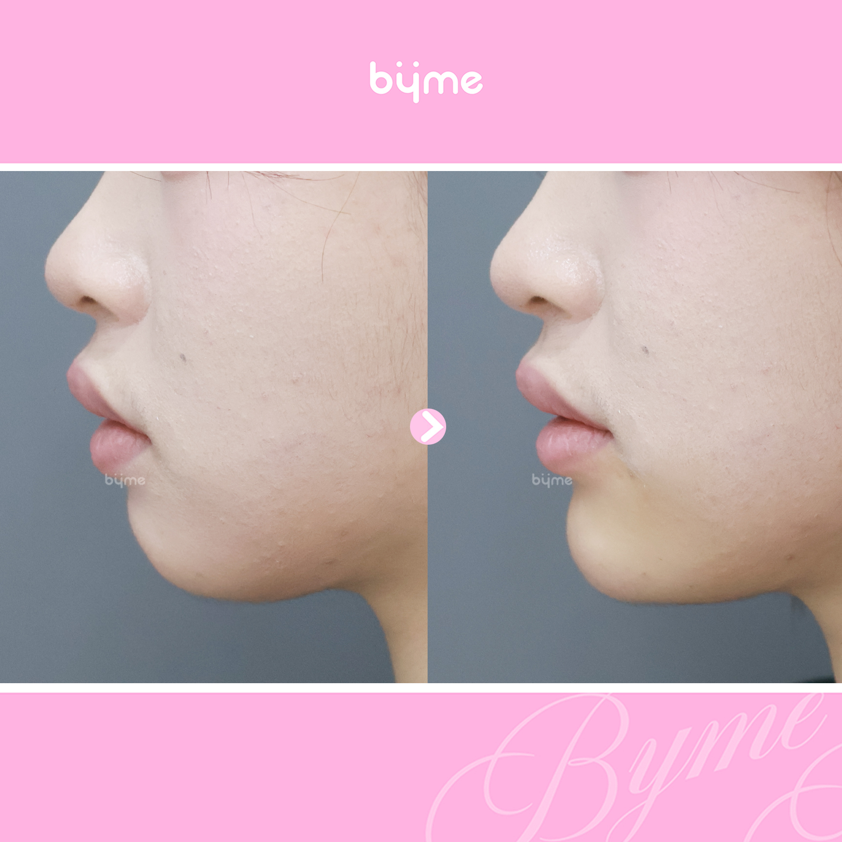 김민주_옆면(byme-chin-filler-seoul-before-after).jpg