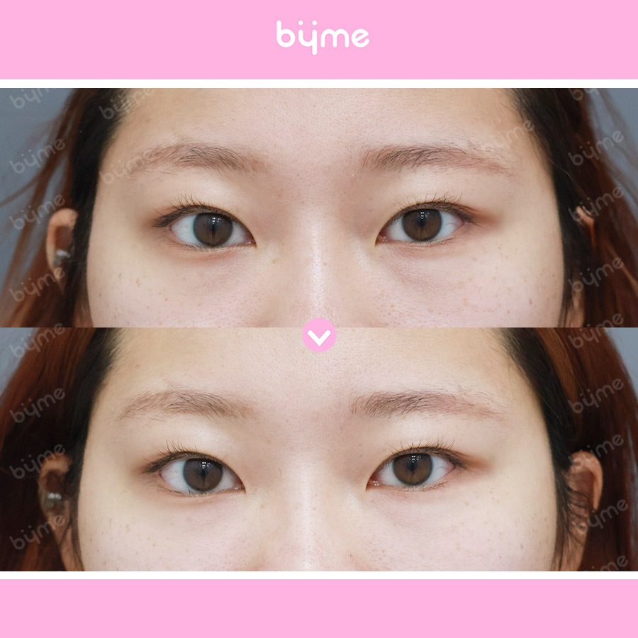 눈밑지방재배치-전후사진-후기(눈밑지02).jpg