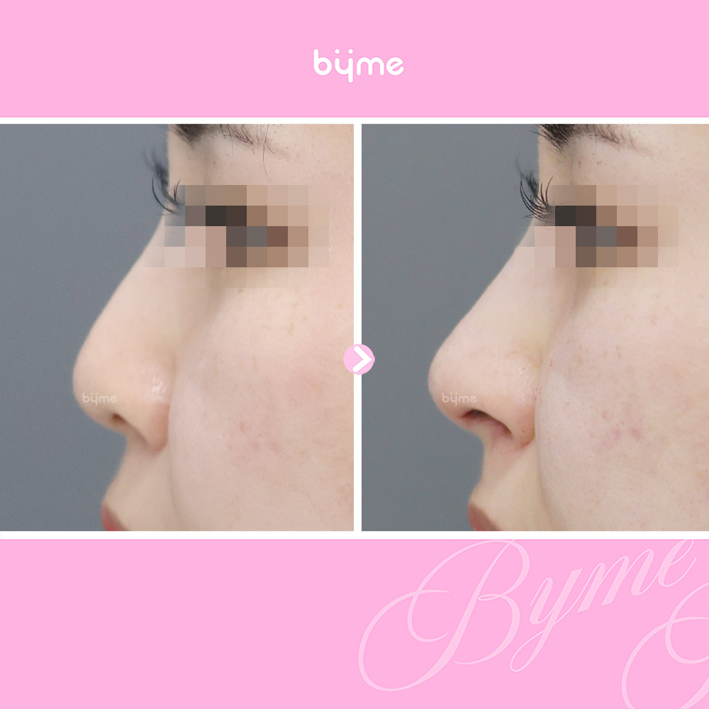 바이미-코프팅-전후사진-02.jpg
