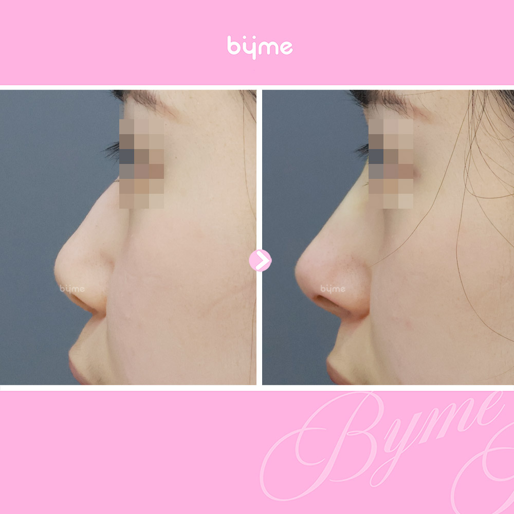 바이미-코프팅-전후사진-06.jpg