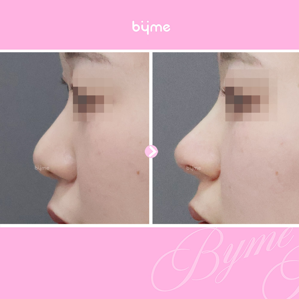 바이미-코프팅-전후사진-08.jpg