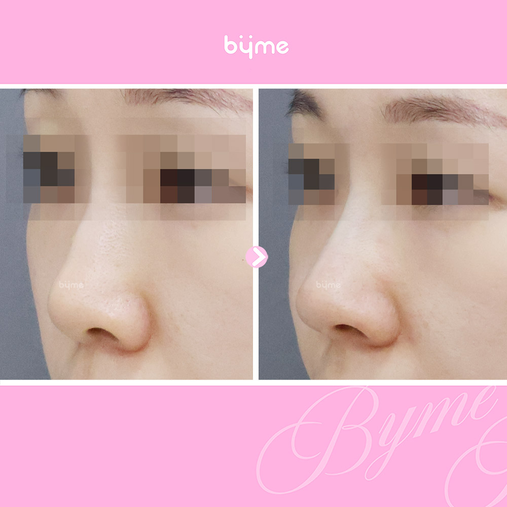 바이미-코프팅-전후사진-07.jpg