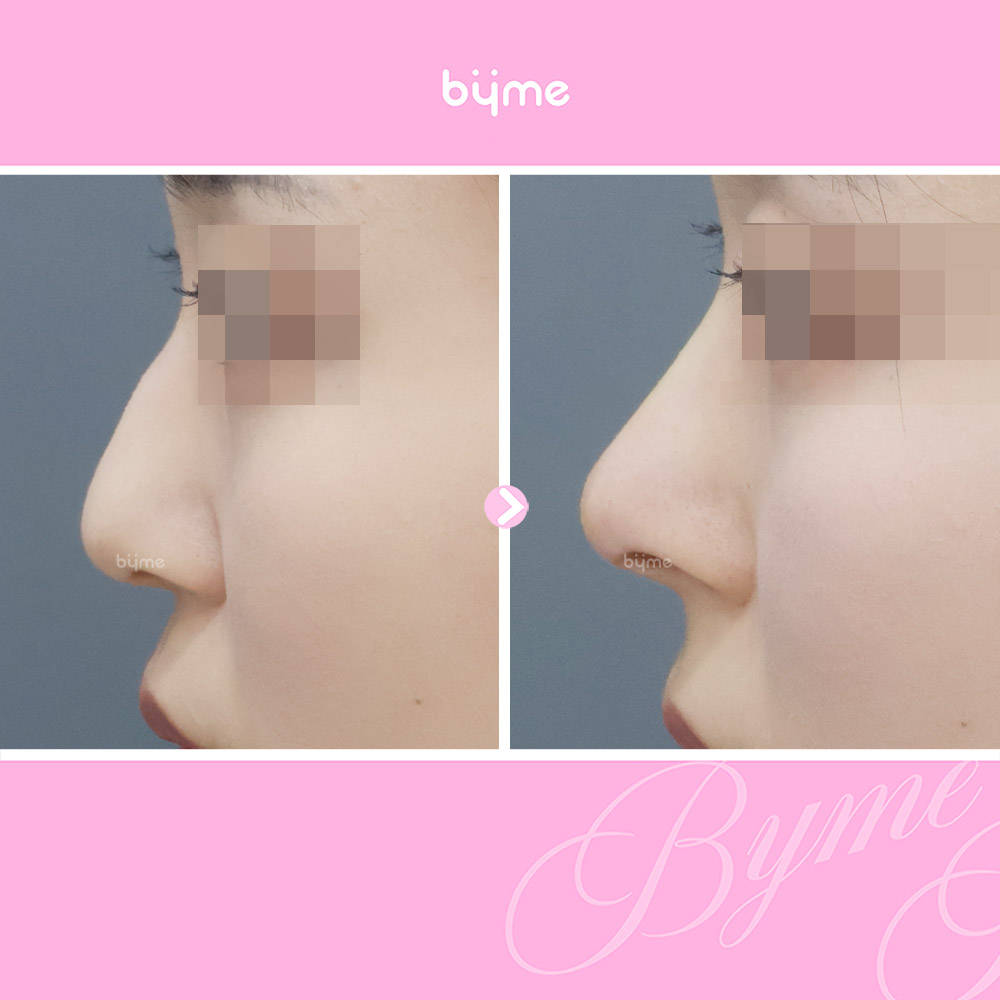 바이미-코프팅-전후사진-09.jpg
