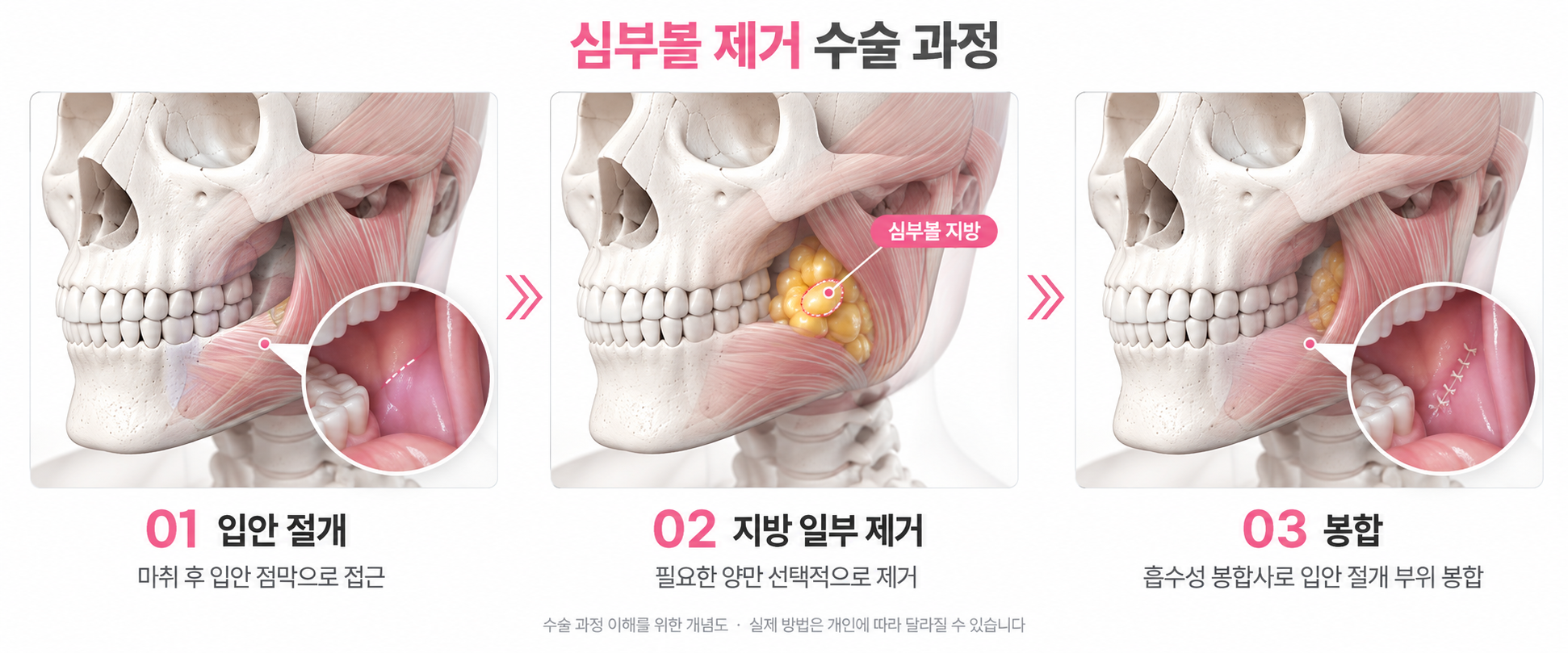 심부볼제거-수술방법-과정-바이미성형외과.png