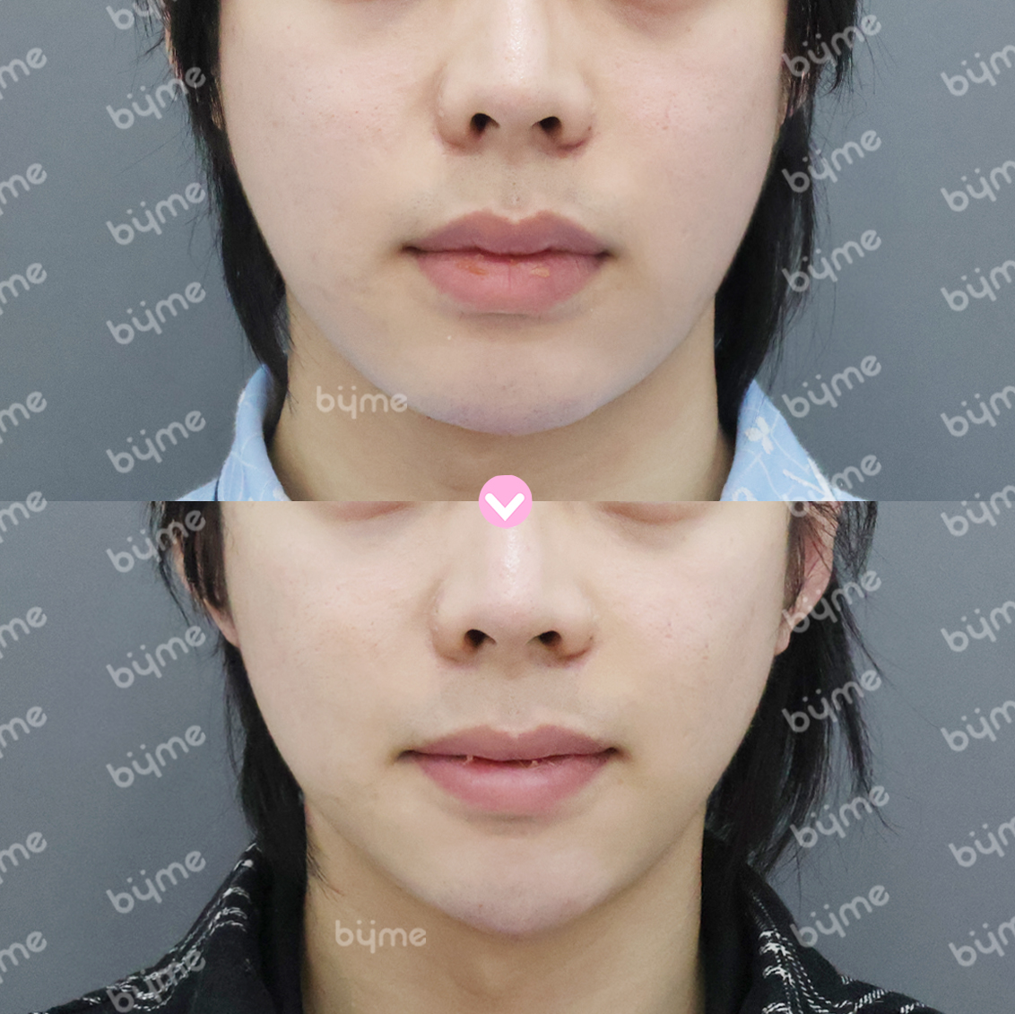 심부볼 제거-전후사진-바이미성형외과02.jpg