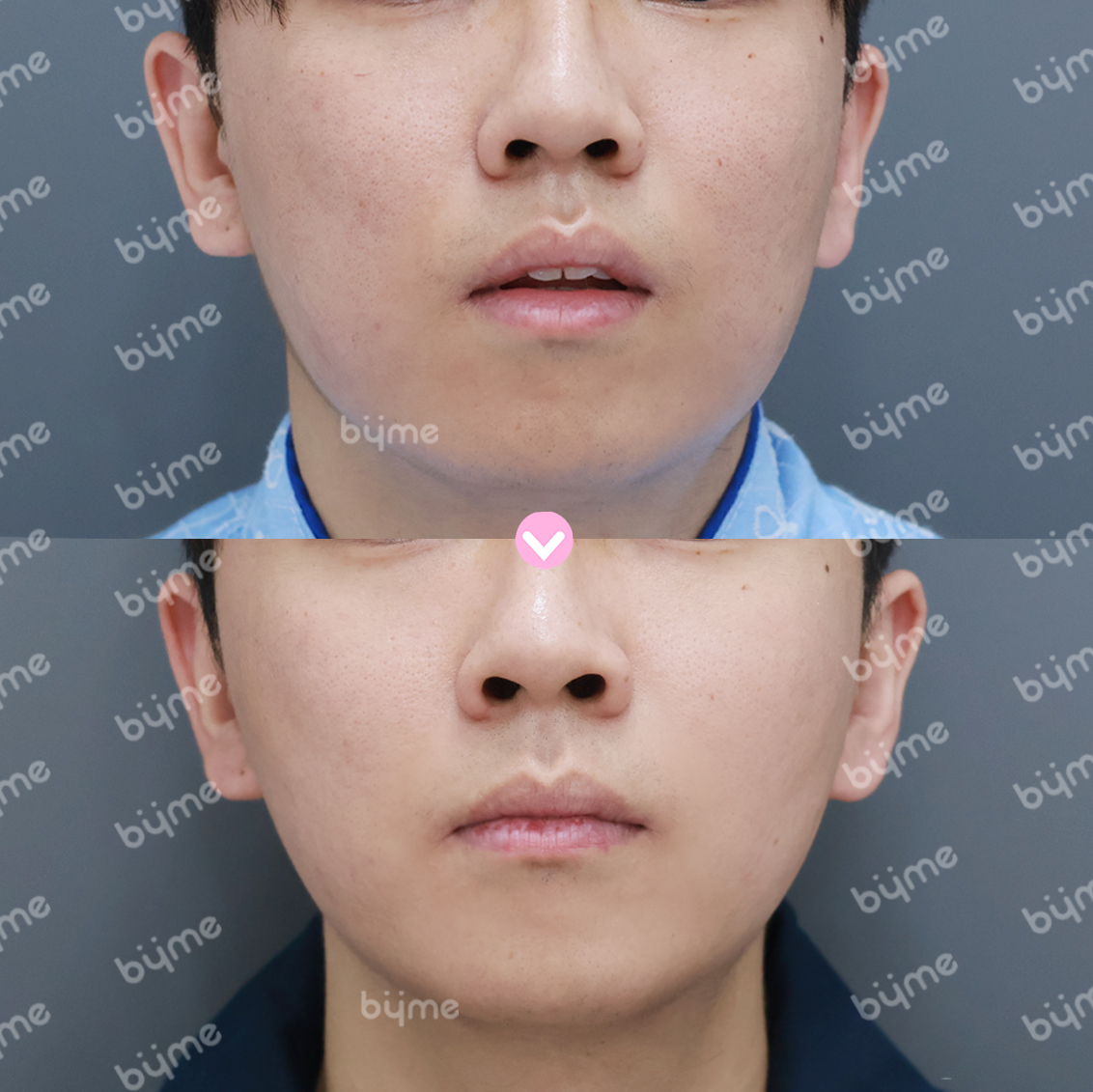 심부볼 제거-전후사진-바이미성형외과03.jpg