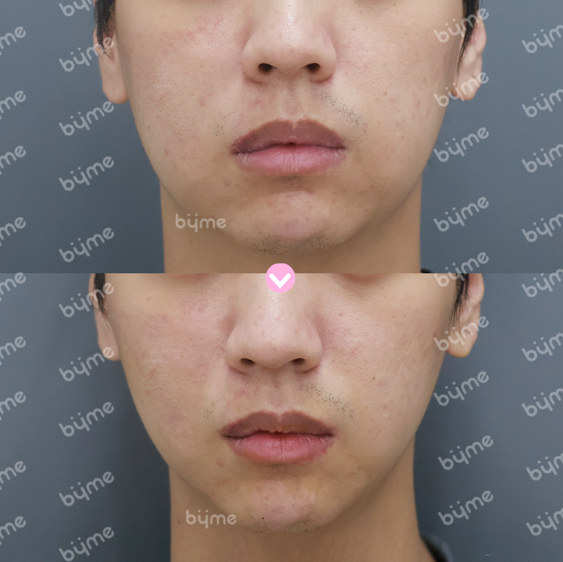 심부볼 제거-전후사진-바이미성형외과04.jpg