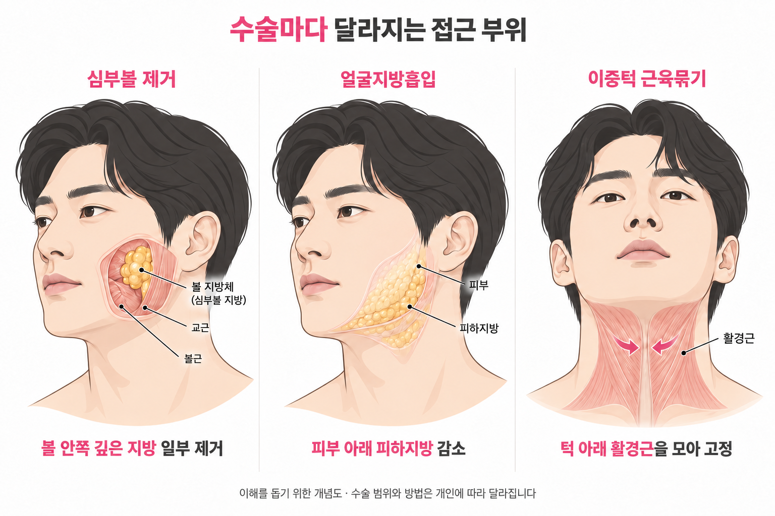 심부볼제거-얼굴지방흡입-근육묶기-차이-바이미성형외과.png